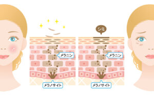 ターンオーバーのイメージ-メラノサイト・メラニン・シミ